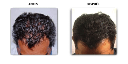 Velform Power Grow Comb | Peine Láser e Infrarrojos Para la Caída del Cabello